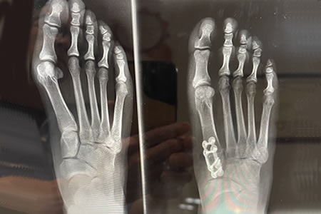 lapiasty 3d bunion correction