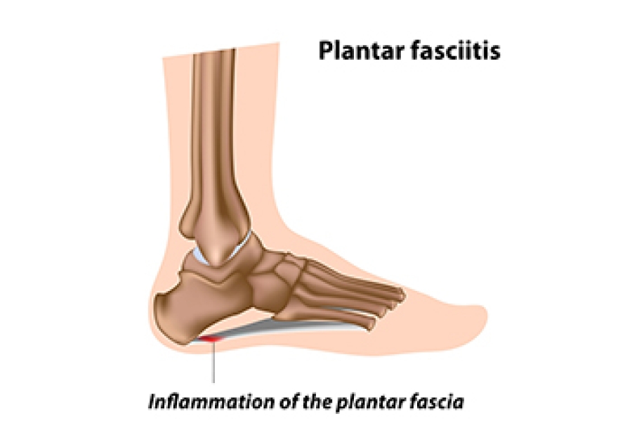 Plantar Fasciitis Treatment  Oklahoma City, OK with FYZICAL