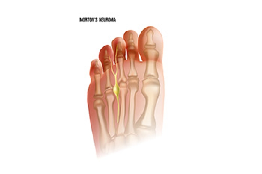 Morton’s Neuroma and Insoles